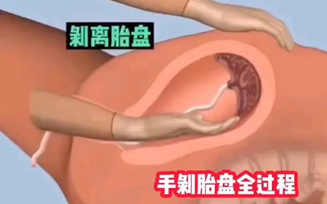胎盘老化能顺产吗