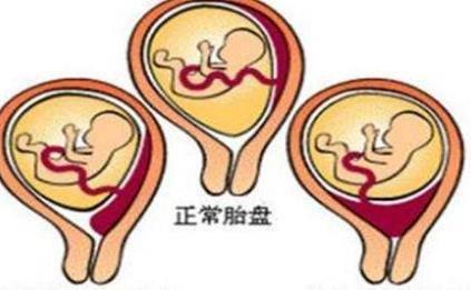 胎盘前壁和胎盘后壁的区别