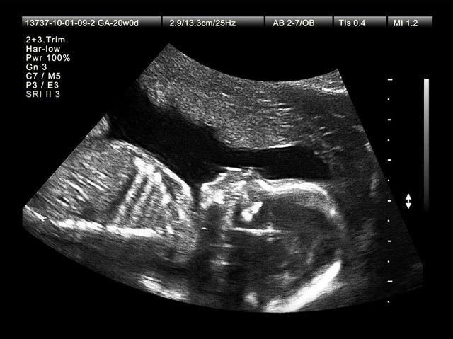 孕期应该做多少次产前超声检查