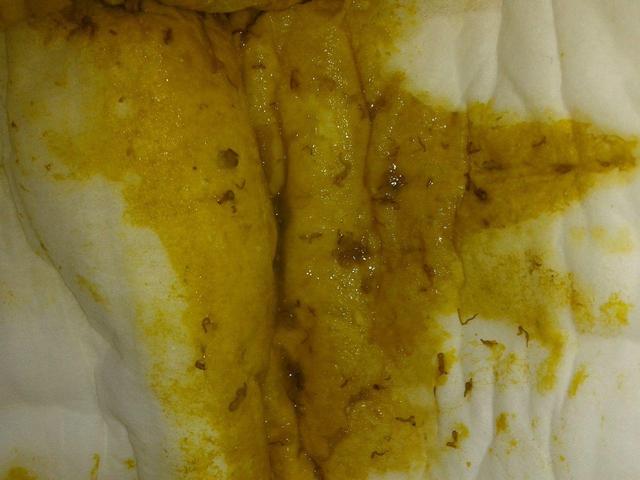 4个月的宝宝拉肚子怎么办拉水