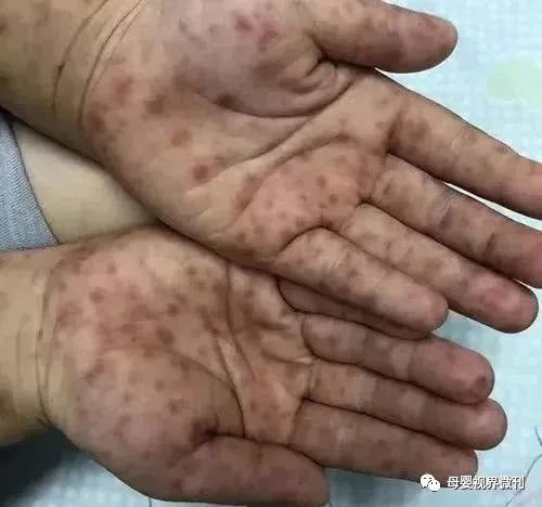 手足口病皮疹好了会不会留疤