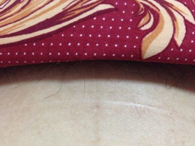 剖腹产后注意事项及护理饮食