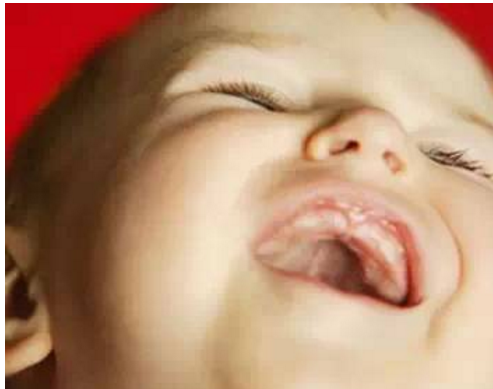 宝宝地图舌是身体有问题吗