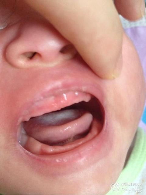 孩子用了抗生素后怎么调理身体