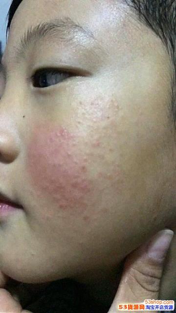 宝宝为什么会红屁股