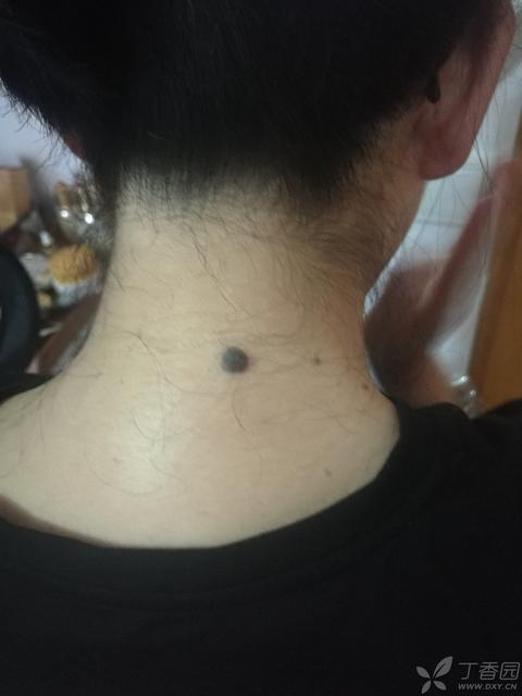 脚底有痣一定要切除吗