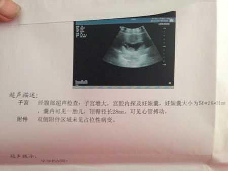 怀孕囊的形状看男女