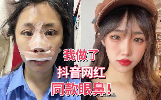 整容vlog-我做了网红同款眼鼻