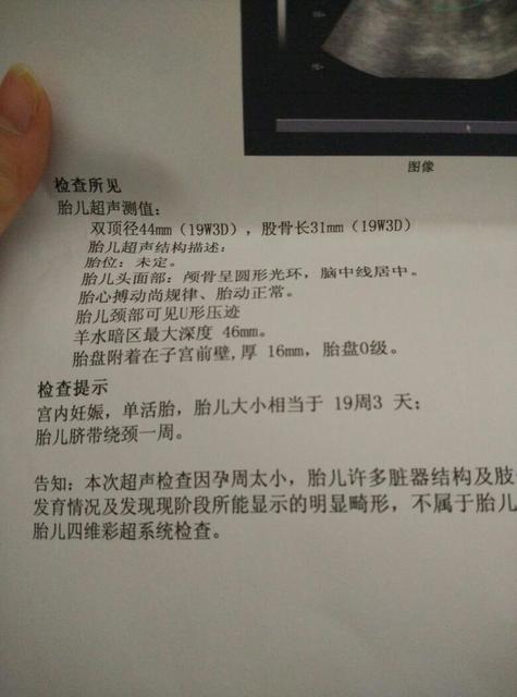 孕妇如何预防脐带绕颈