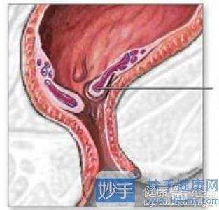 孩子得痔疮的多吗