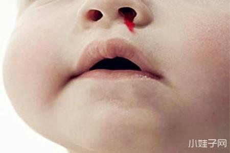 孕妇鼻子内出血是怎么回事
