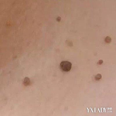 如何预防宝宝夏天长痱子