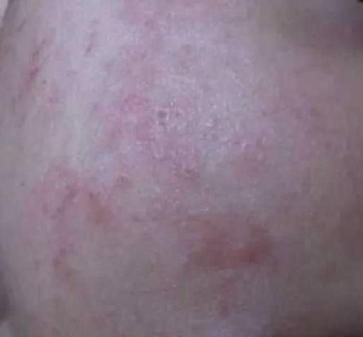 婴儿皮肤过敏要注意什么