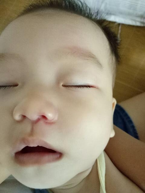 婴儿摔伤了怎么办