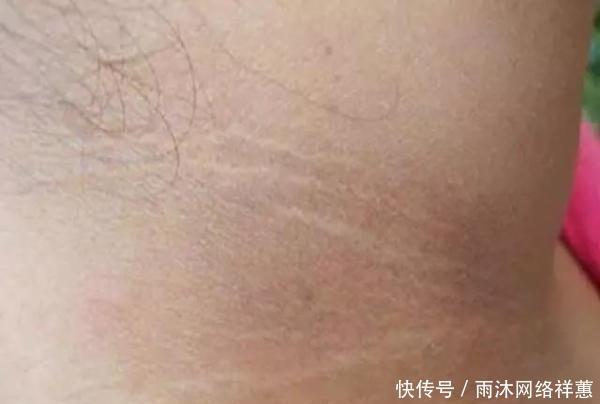 爱喝碳酸饮料脖子发黑真的吗