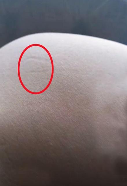 明星是怎么消除妊娠纹的