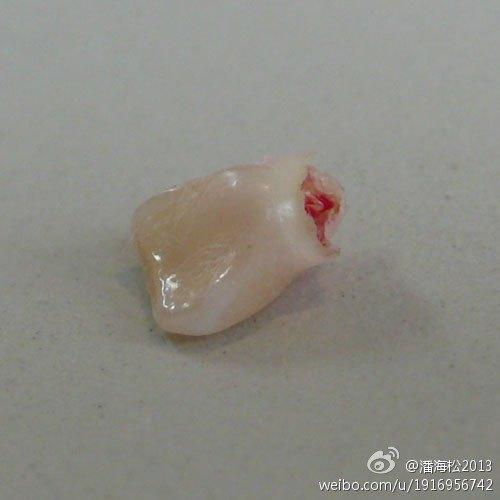 儿童乳牙坏了有必要拔掉吗