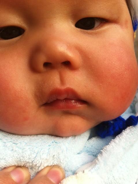 宝宝老爱过敏怎么办