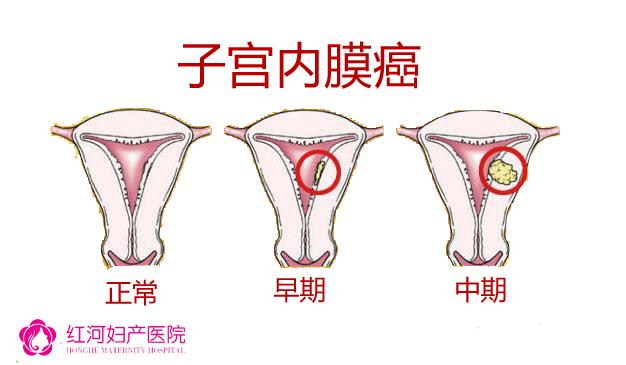 子宫后内膜长不起来怎么办