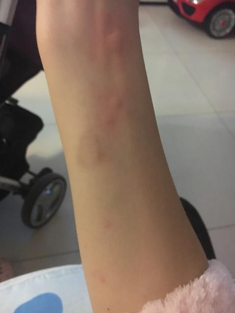什么样的疹子是皮炎和湿疹
