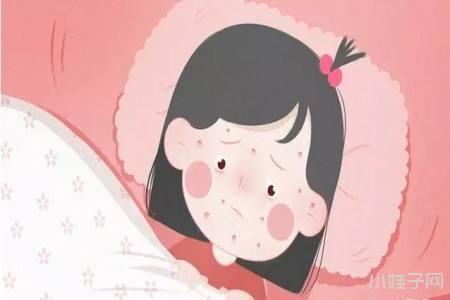 一岁宝宝出水痘怎么办