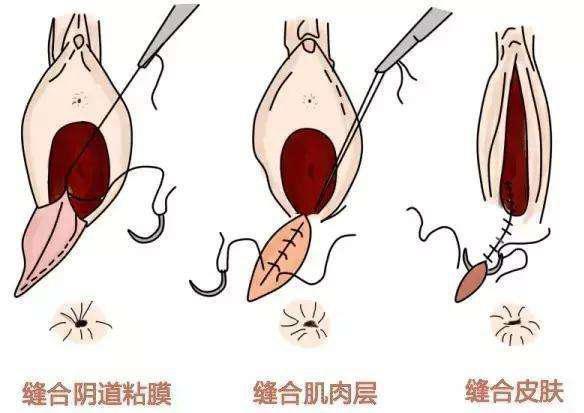 顺产撕裂伤口怎么护理恢复快