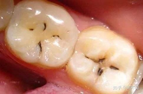 孩子牙齿上的黑斑是什么原因