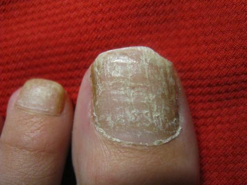 怎样判断自己是不是有灰指甲