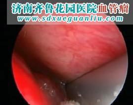 宝宝血管瘤是什么