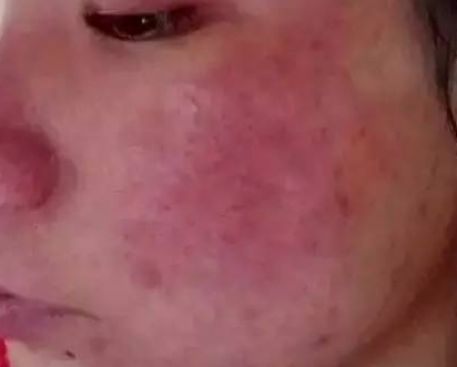 孩子皮肤过敏是什么原因导致的