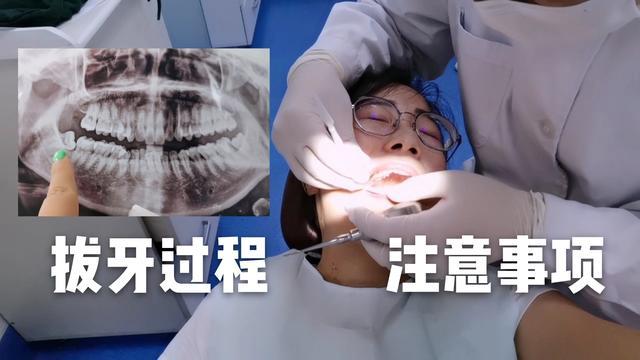 智齿是如何自己拔出来的