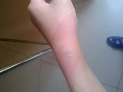 哪些会引起宝宝皮肤过敏