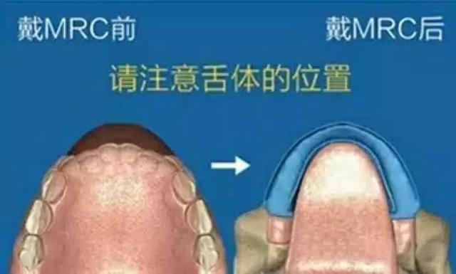 牙齿反颌是什么原因造成的