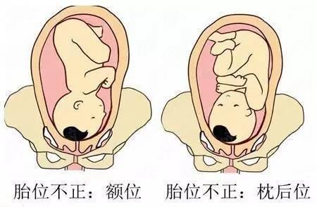 臀位对胎儿的危害