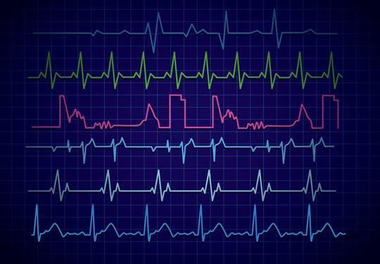 波形视频技术发光生病医院心跳心脏病专家心脏病学心脏跳动