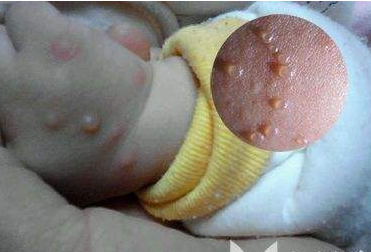 新生儿水痘图片图片