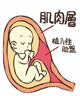 胎盘植入一般多少周剖腹产