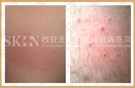 婴儿皮肤过敏怎么办最快方法