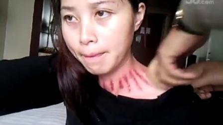 美女揪痧
