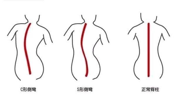 孩子脊柱侧弯还可以复原吗