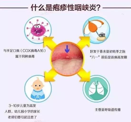 小儿疱疹性咽颊炎有什么症状