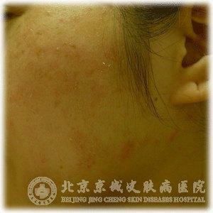 如何防治小儿尿布性皮炎