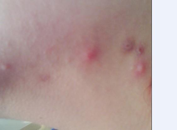 内分泌失调会引起不孕吗?