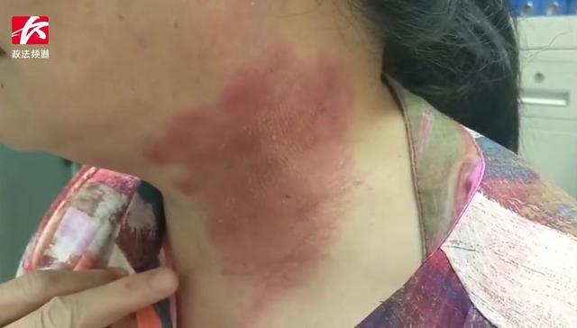 宝宝被虫咬了有水泡怎么办