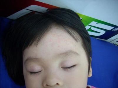 手足口病得过一次还会再得吗?