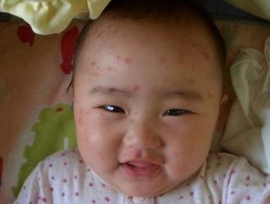 孩子得水痘有什么症状