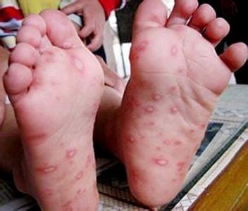 小宝宝怎么预防手足口病