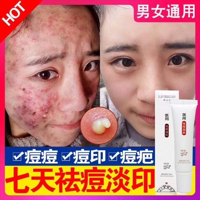下巴经常容易长痘痘是什么原因