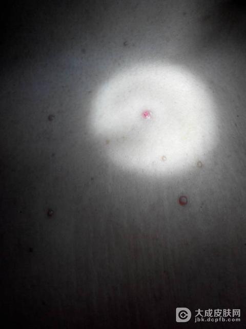 宝宝长了传染性软疣怎么办