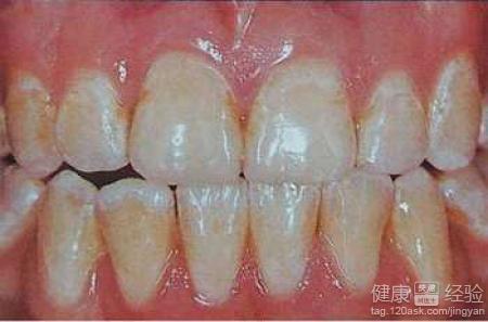 小孩指甲有一个凹陷的小窝怎么办